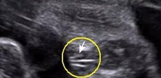 四维彩超看男女这么简单, 学到了