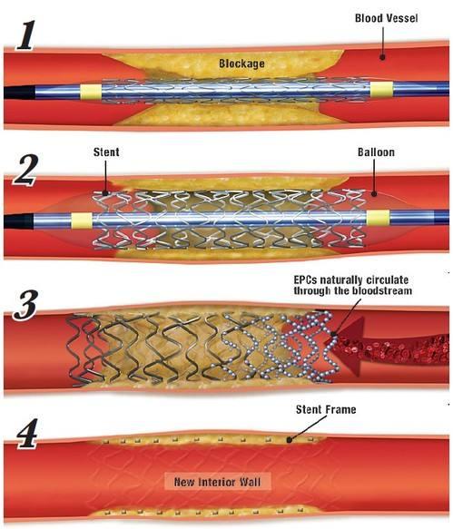 冠心病为什么放支架支架的费用支架的风险支架的寿命