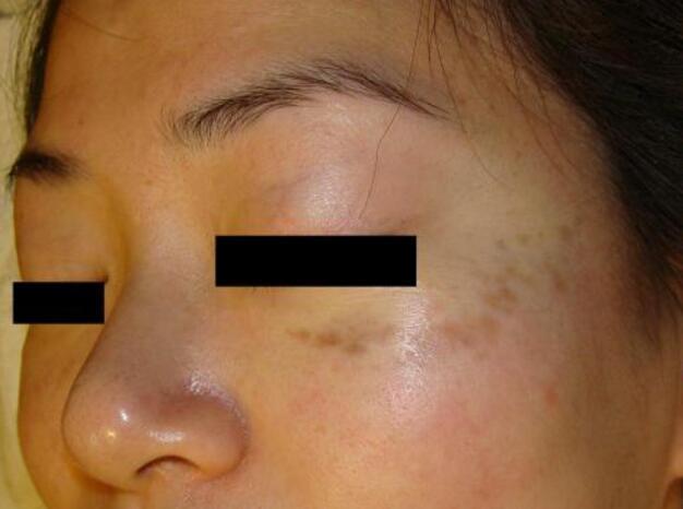 黑色素|祛斑|葡萄多酚_新浪新闻