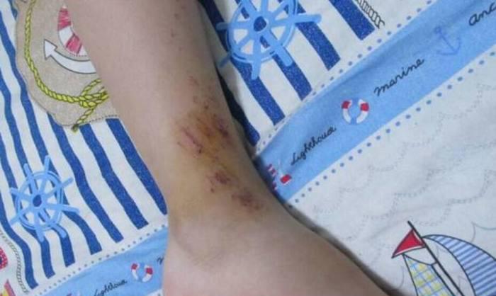 看着孩子脚上的伤,我说了三个字,孩子在学校再没被欺负