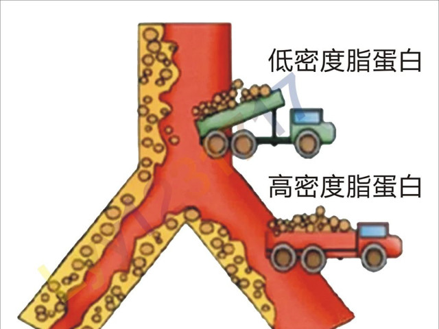 膽固醇|動脈粥樣硬化|脂肪_新浪新聞