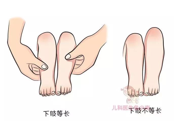 宝宝腿纹不对称就是髋关节发育不良吗?越早发现越好