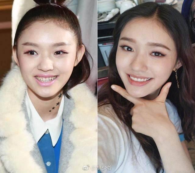 这些明星整牙堪比整容,杨幂方脸变v脸|杨幂|牙齿|整容_新浪新闻