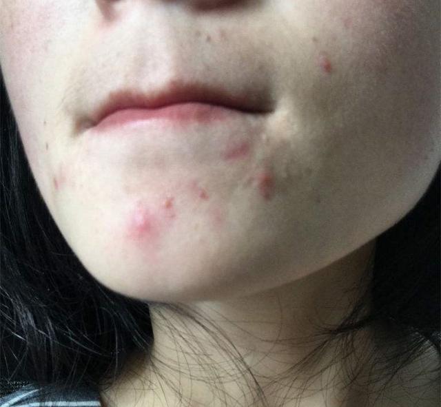 女生下巴有小痘痘千万要注意它的存在不然后悔也来不及