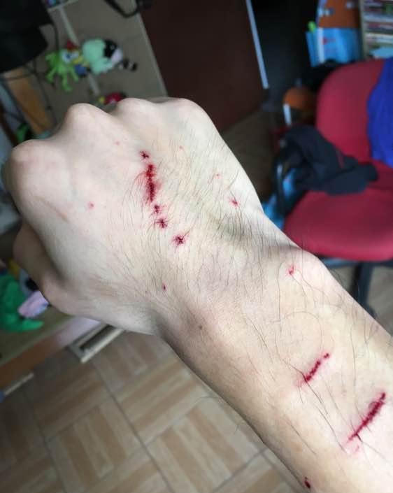 被一只猫给咬成3级伤情我恐怕是第一人了该炖了