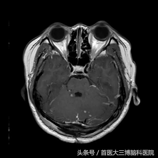 脑血管母细胞瘤为良性肿瘤,以青壮年为主,好发于20～40岁,男性多于