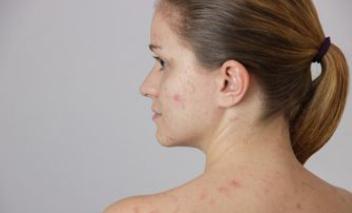 自己身上越来越痒,每天洗澡洗不干净,小高住了三个月,背部发痒难受