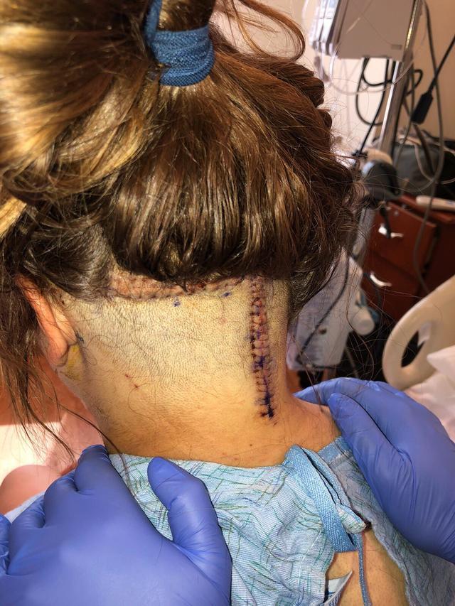 妹妹脑瘤手术头上留20厘米伤疤,为支持妹妹哥哥把发型剃成伤疤样