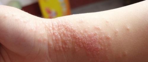 老人口中说的"胎毒"真有其事?如何去"胎毒"?