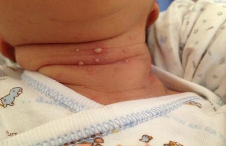 新生儿脓疱疹的护理和预防方法|脓疱疹|新生儿|宝宝_新浪新闻