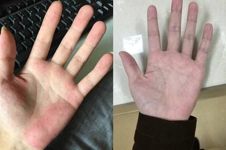 图正常手掌与肝掌比较健康小常识时刻谨记