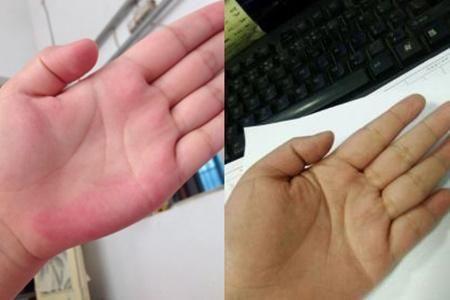 【图】正常手掌与肝掌比较 健康小常识时刻谨记!|肝掌|手掌|肝脏_新浪新闻