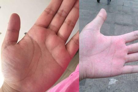 图正常手掌与肝掌比较健康小常识时刻谨记