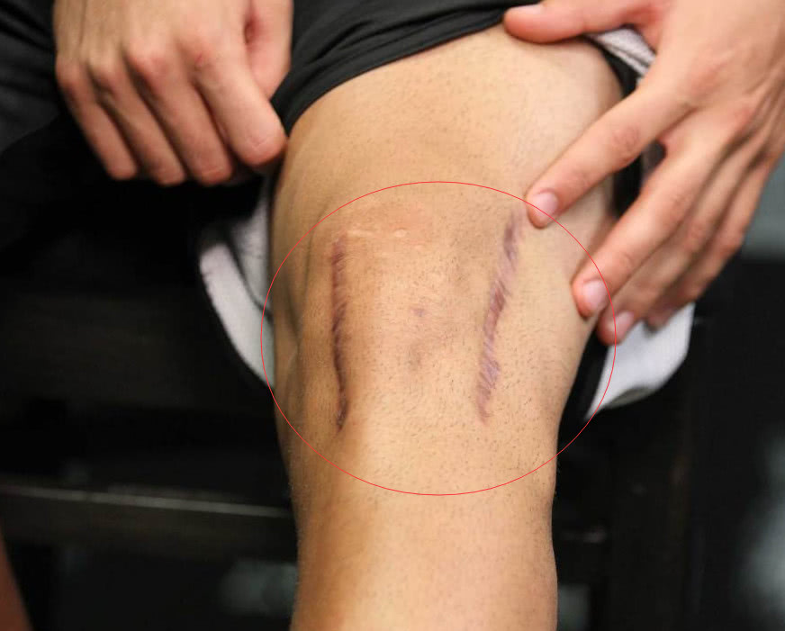 盘点nba球星术后恐怖伤疤:科比超20厘米,他横穿上半身