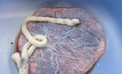 女子剖腹产下双胞胎, 第4天被家人逼着出院, 刚出门又被送回医院