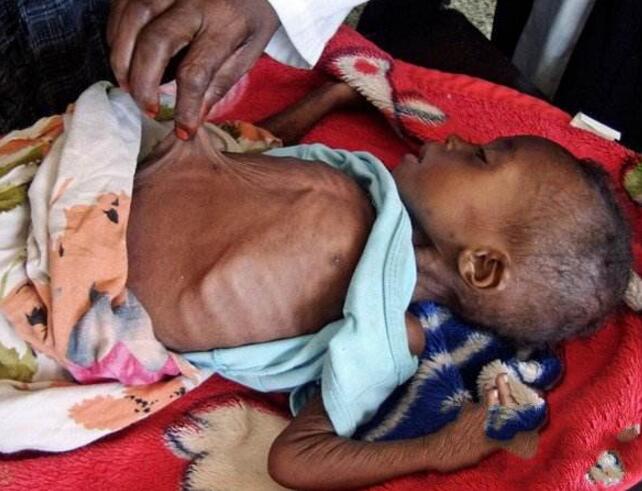 这儿的孩子骨瘦如柴,有东西吃就不哭,可有很多孩子死在母亲怀里