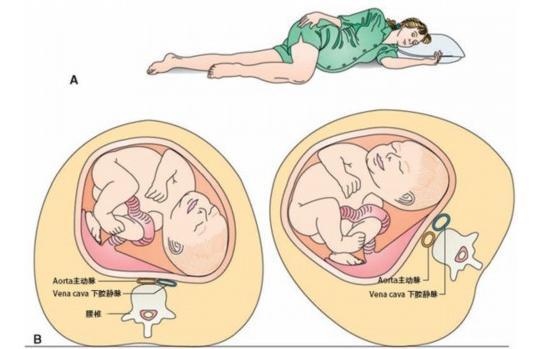 仰卧位低血压综合征",这对产妇和胎儿都是很危险的.