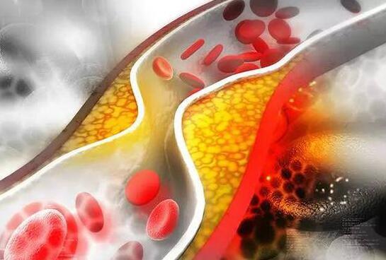 高血脂来袭会有三种症状日常做到三合理血脂自然降
