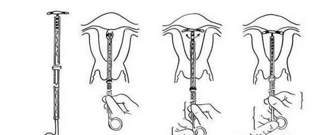 女性取环过程是怎么样进行的呢这个过程会不会痛