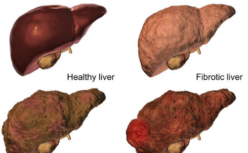 肝硬化早期,采取这2个措施,可以让肝硬化"逆转"|肝硬化|肝脏|逆转