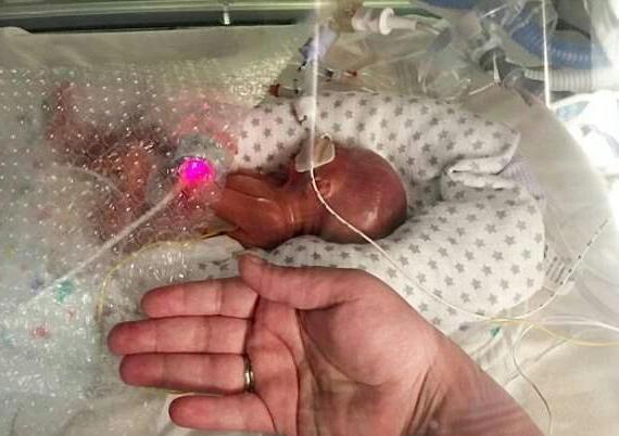 孕妈怀孕7月才堕胎, 谁料孩子竟自己出生了, 父母决定不放弃他了