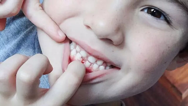 【牙齿正畸】矫牙,几岁开始合适?