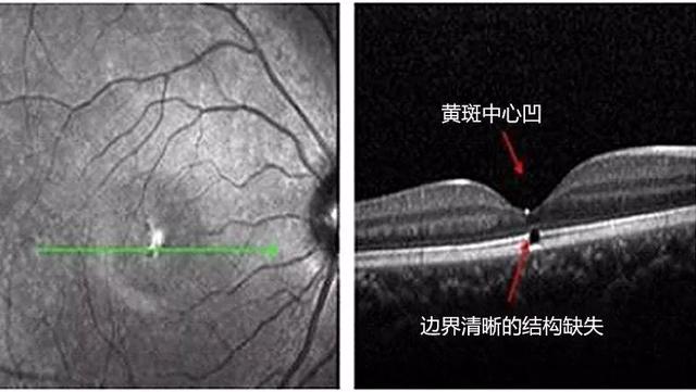 棘手,希望也渺茫中山大学中山眼科中心眼外伤科主任郑永欣教授表示