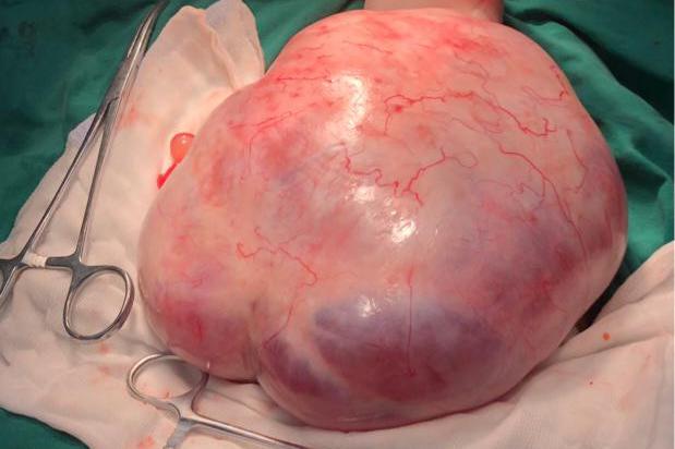 19岁女孩月经不规律原来盆腔中有巨大包块图