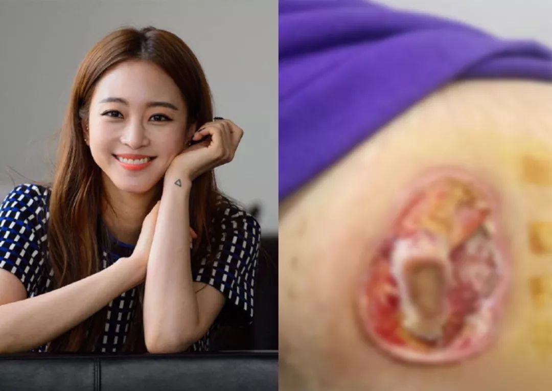灼伤毁容!韩女歌手再爆医疗事故导致脸部毁容 造成永久烧伤….
