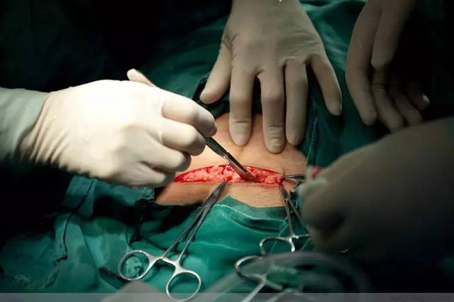 直击剖腹产过程现场触目惊心的100张照片