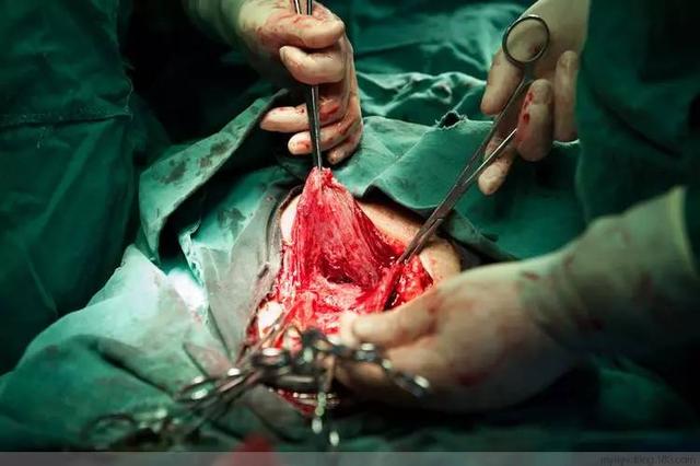 直击剖腹产过程现场,触目惊心的100张照片|手术|剖腹产|伤口_新浪新闻