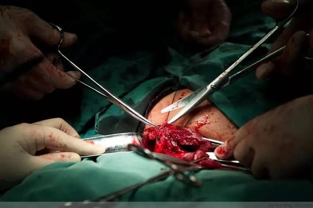 直击剖腹产过程现场触目惊心的100张照片