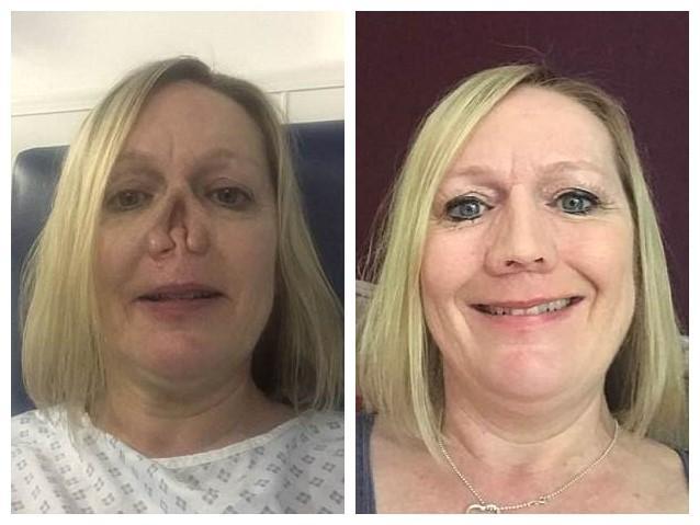 英国女士有一盒子假鼻子挑选佩戴只因她罹患疾病失去原装款