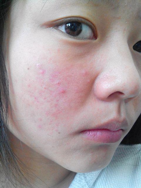 女人脸上长痘,想祛痘印?要特别注意这两个"方法"!养肤还美颜