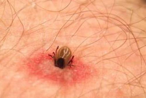 孩子在小区草坪玩耍后身上莫名长"痣",原来是虫子钻进了皮肤!