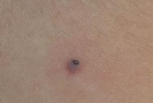 孩子在小区草坪玩耍后身上莫名长"痣",原来是虫子钻进了皮肤!