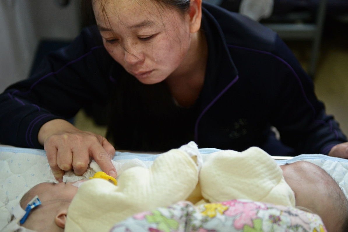 她不顾医生建议冒险胞胎,连体婴儿诞生后遭受磨难