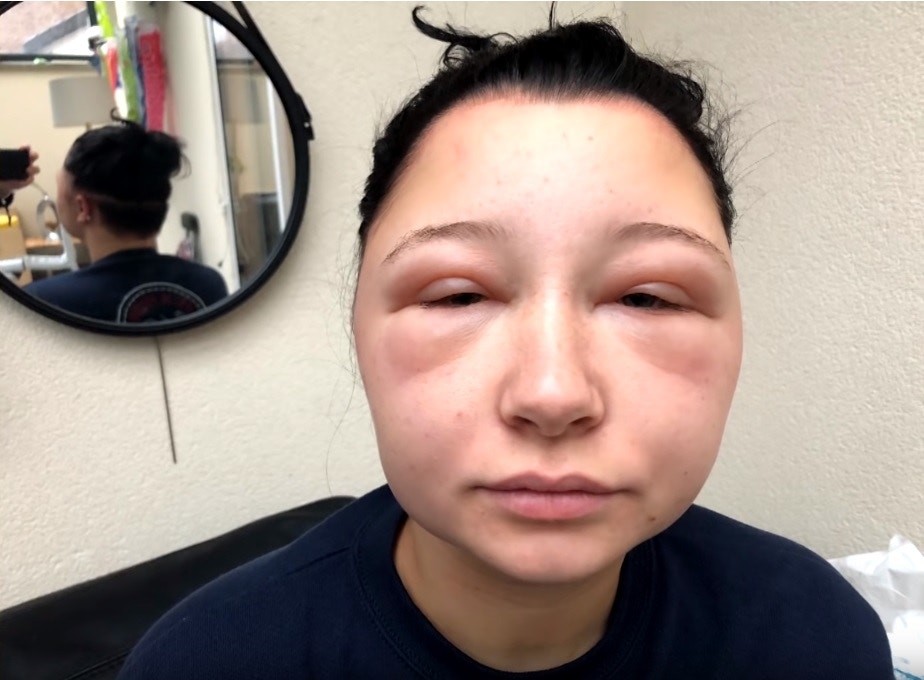 19岁少女用染发剂过敏头肿如灯泡呼吸困难差点丧命