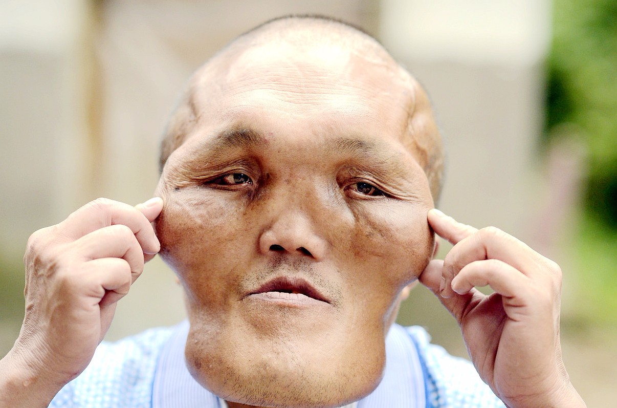 重庆5旬农民头大如盆,像"南极仙翁",耳朵失聪,从不抱怨生活