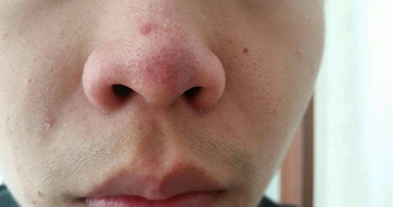 重口味为什么挤黑头有快感