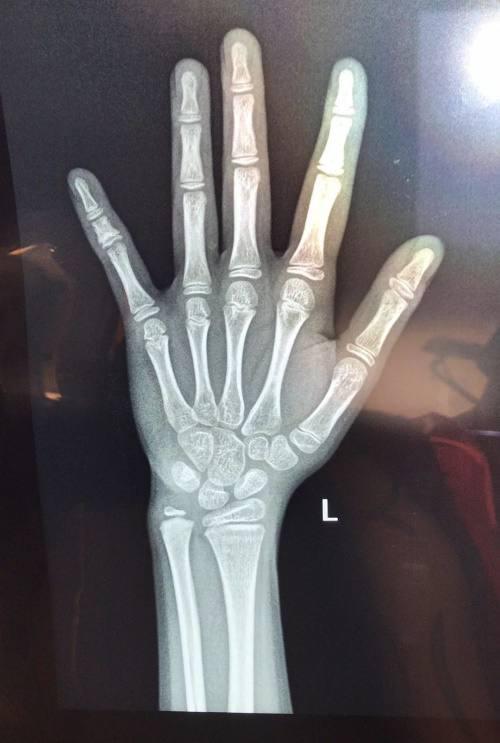 骨龄|发育|x光片_新浪新闻