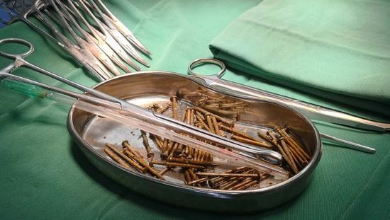 医生介绍,经过检查和手术证实,这个小伙子吞食了87根铁钉和7枚图钉
