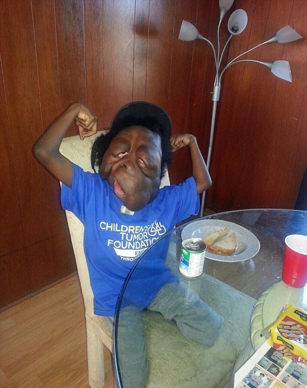 8岁童患罕病脸严重变形 妈妈: 比病痛更让人难过的是嘲笑