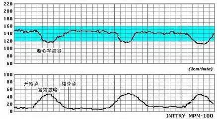 一招教你如何看懂胎心监护图