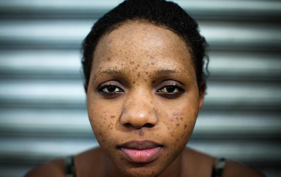 这些非洲的黑皮肤美女为了更美, 不惜重金只为漂白皮肤?