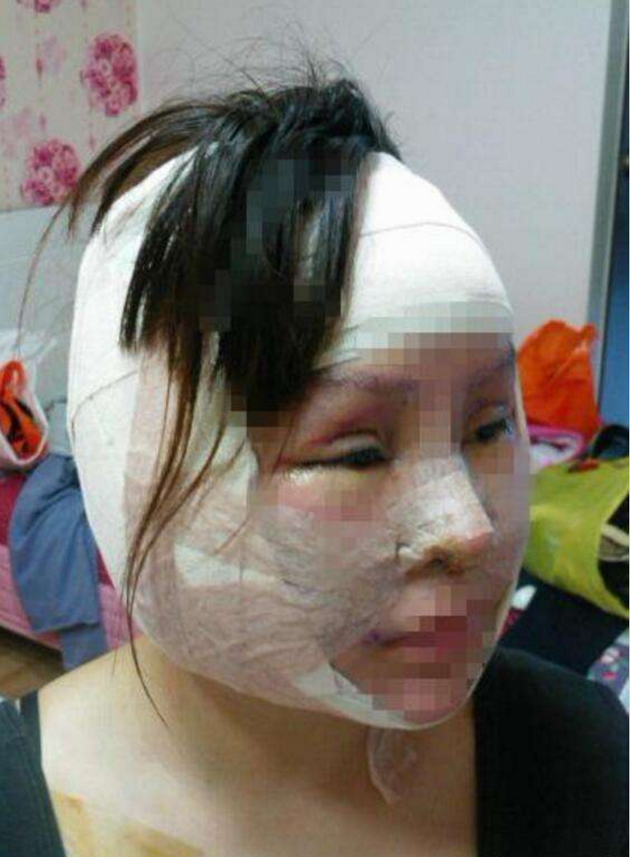 女子16岁开始整容, 花巨款整形200次, 整后样子让人看了心惊