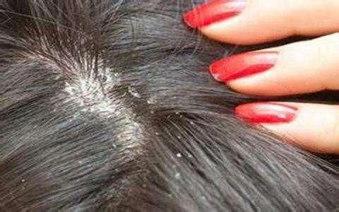 头皮屑不仅多,可以进来看看这篇文章|头皮屑|头皮|症状_新浪新闻