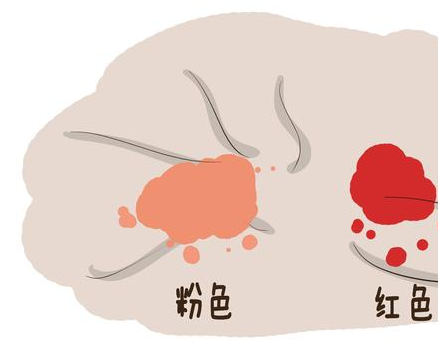 着床出血一些女性在受精6天后,会有着床出血状况,流出红色或粉红色的