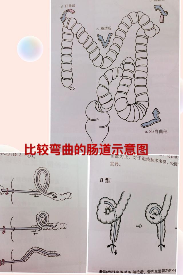 为什么我做肠镜痛死了,别人却说没感觉?做肠镜要注意些什么?