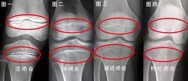 儿童每根长骨的两端都有骨骺线,当骨骺线还未闭合的时候(如下图),会